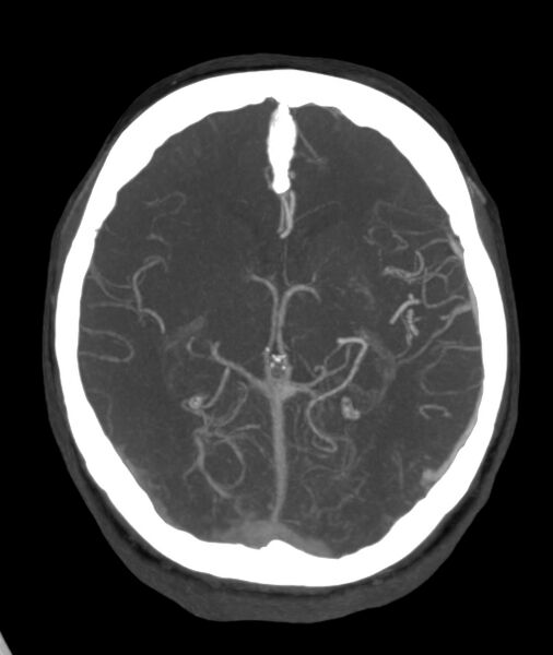 File:Acute right MCA M1 occlusion (Radiopaedia 62268-70454 Axial Phase 1 15).jpg