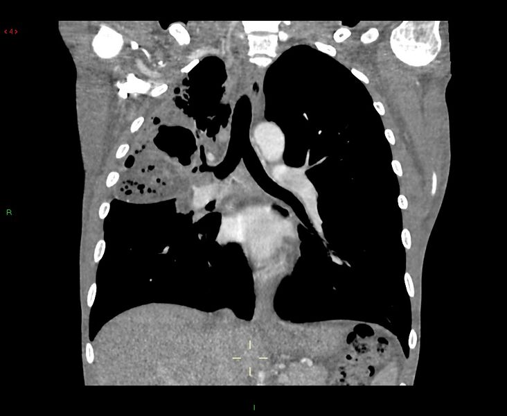 File:Acute right lung abscess (Radiopaedia 34806-36258 Coronal C+ arterial phase 27).jpg