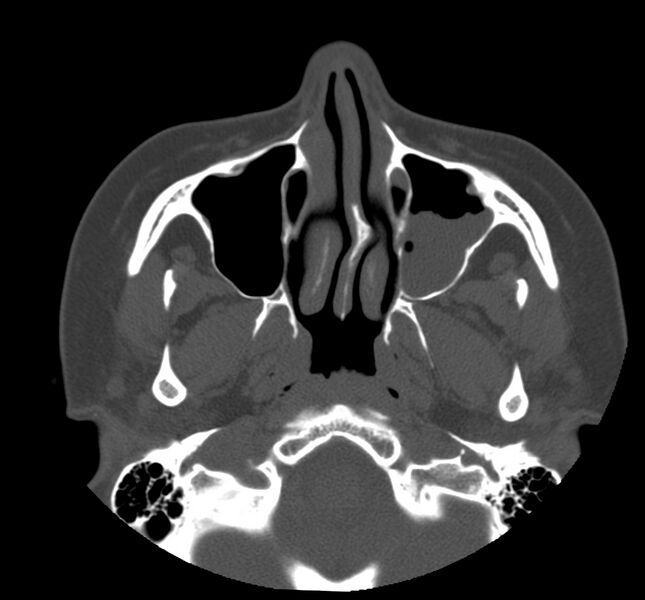 File:Acute sinusitis (Radiopaedia 22419-22455 Axial non-contrast 11).jpg