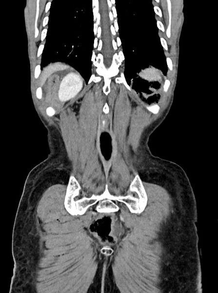 File:Acute small bowel (ileal) volvulus (Radiopaedia 71740-82139 Coronal C+ portal venous phase 97).jpg