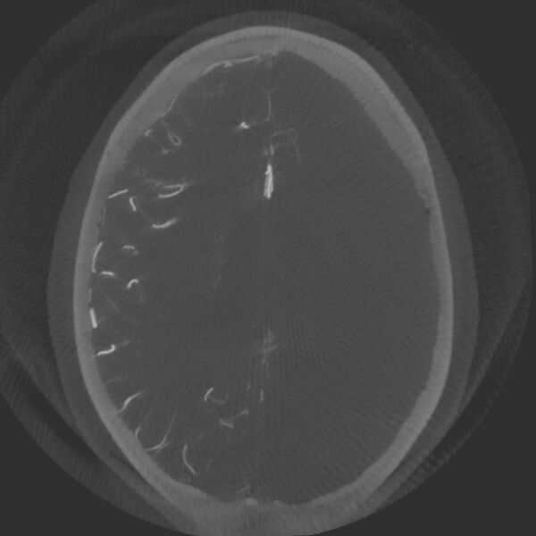 File:Acute subarachnoid hemorrhage and accessory anterior cerebral artery (Radiopaedia 69231-79010 Axial arterial - MIP 55).jpg