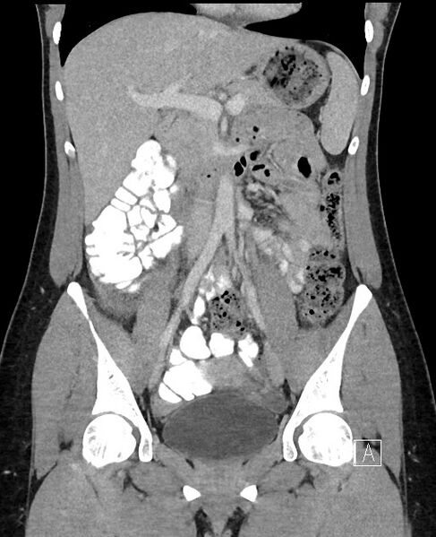 File:Acute uncomplicated appendicitis (Radiopaedia 61374-69304 Coronal C+ portal venous phase 46).jpg
