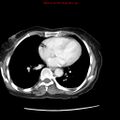 Adenocarcinoma of the colon (Radiopaedia 8191-9039 Axial liver window 1).jpg