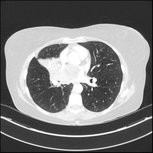 File:Adenocarcinoma of the lung (Radiopaedia 44205-47803 Axial lung window 52).jpg