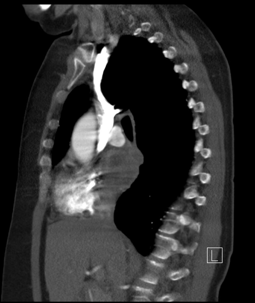 Adenocarcinoma of the lung (Radiopaedia 44205-47803 Sagittal C+ portal venous phase 32).jpg