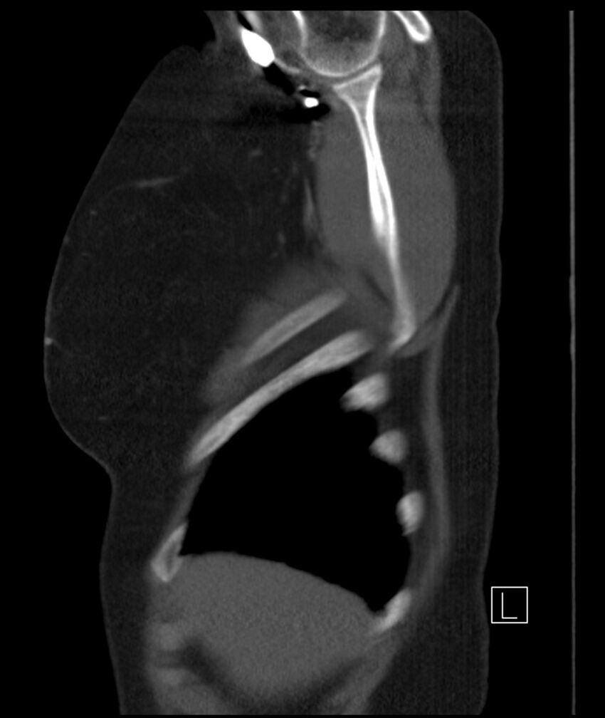 Adenocarcinoma of the lung (Radiopaedia 44205-47803 Sagittal C+ portal venous phase 52).jpg