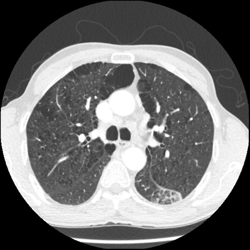 Adenocarcinoma of the lung - micropapillary predominant (Radiopaedia 42446-45563 C 12).jpg