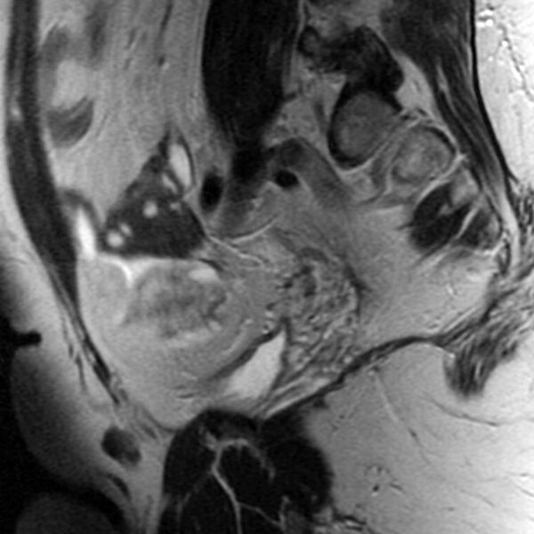 File:Adenomyosis of the uterus (Radiopaedia 9869-10437 Sagittal T2 7).jpg