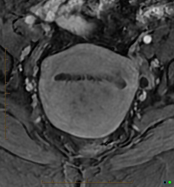 File:Adenomyosis uterus with hematometra (Radiopaedia 45779-50011 Axial T1 C+ fat sat 25).jpg