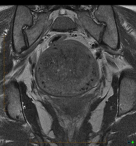 File:Adenomyosis uterus with hematometra (Radiopaedia 45779-50011 Coronal T2 16).jpg