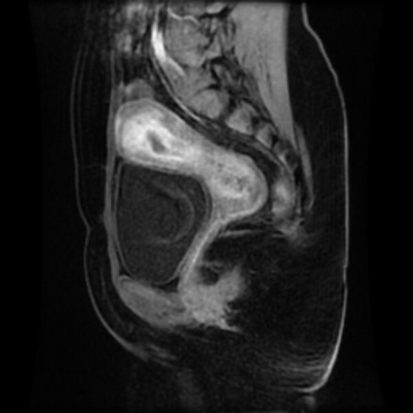 File:Adenomyosis within a septate uterus (Radiopaedia 69963-79981 Sagittal LAVA-Dyn 20).jpg