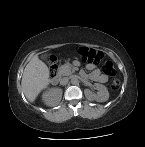 File:Adrenal cortical carcinoma with IVC invasion and thrombosis (Radiopaedia 34307-35597 Axial non-contrast 20).jpg