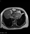 Adrenal myelolipoma (Radiopaedia 6765-7961 Axial T1 out-of-phase 1).jpg