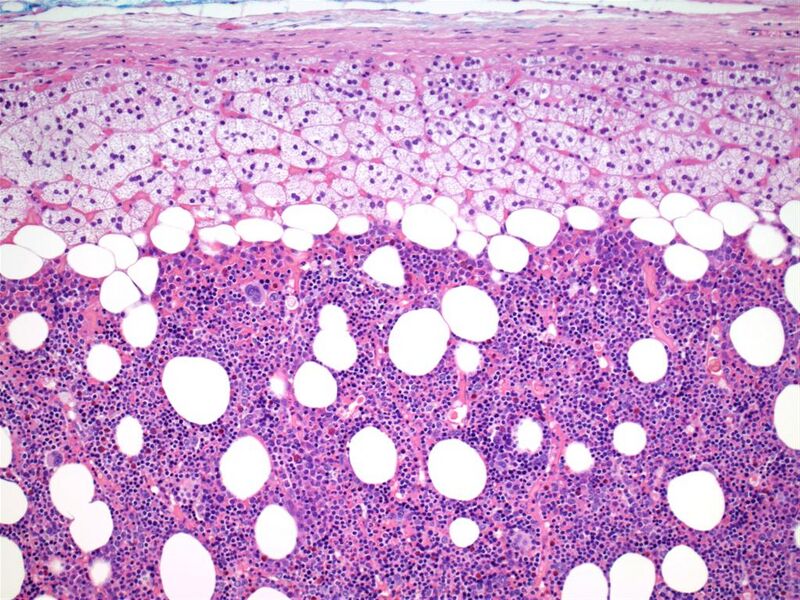 File:Adrenal myelolipoma (pathology) (Radiopaedia 19001-18961 100x H&E 1).jpg