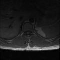 Aggressive vertebral hemangioma (Radiopaedia 39937-42404 Axial T1 10).png