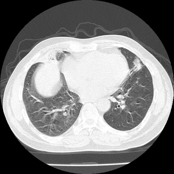 File:Airway foreign body in adult (Radiopaedia 85907-101779 Axial lung window 123).jpg
