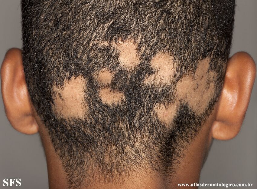 Alopecia Areata (Dermatology Atlas 63).jpg