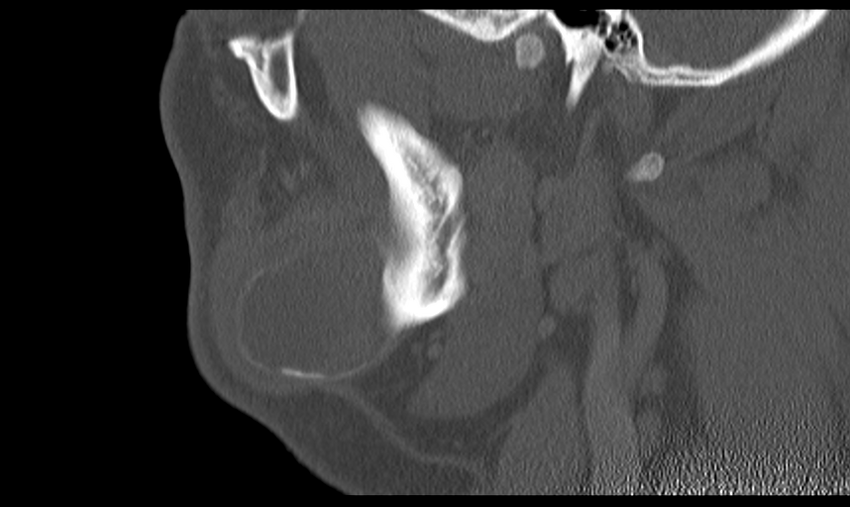 Ameloblastoma (Radiopaedia 33677-34806 Sagittal bone window 19).png
