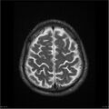 Amnestic syndrome secondary to hypoxic brain injury (Radiopaedia 24743-25004 T2 18).jpg