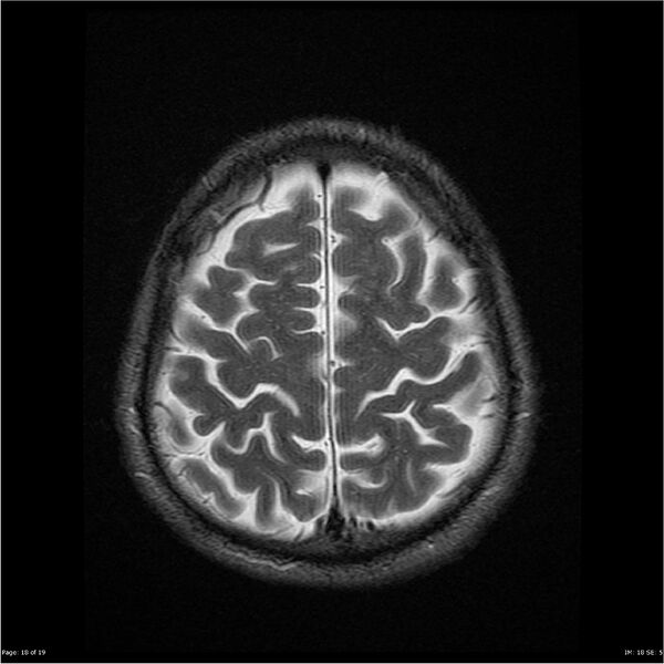 File:Amnestic syndrome secondary to hypoxic brain injury (Radiopaedia 24743-25004 T2 18).jpg