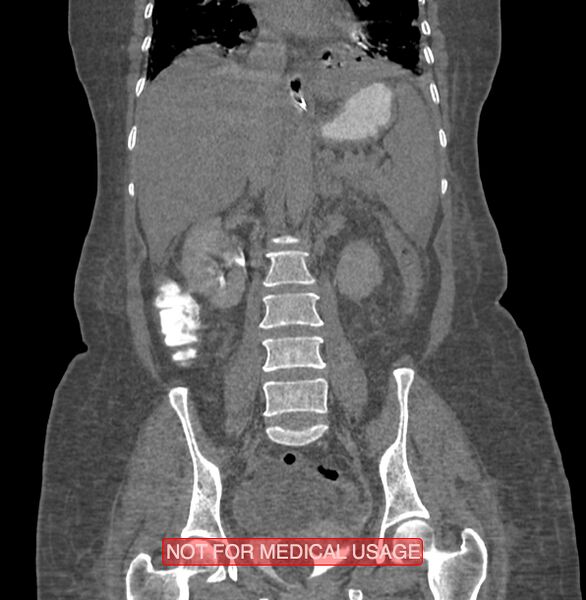File:Amoebic enterocolitis with liver abscess (Radiopaedia 35100-36609 B 121).jpg