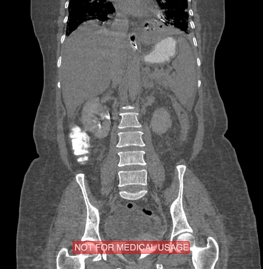 Amoebic enterocolitis with liver abscess (Radiopaedia 35100-36609 B 121).jpg