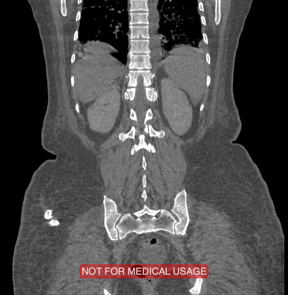 File:Amoebic enterocolitis with liver abscess (Radiopaedia 35100-36609 B 165).jpg