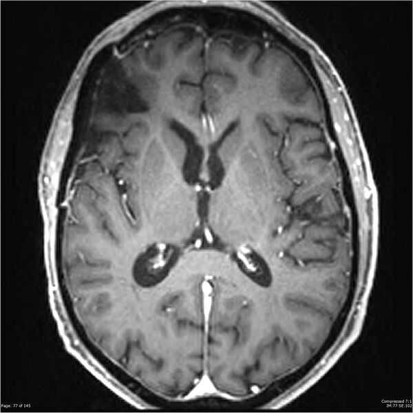 File:Anaplastic meningioma with recurrence (Radiopaedia 34452-35788 Axial T1 C+ 77).jpg