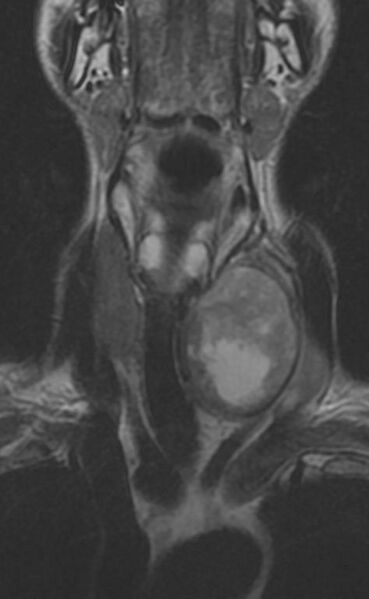 File:Anaplastic thyroid cancer (MRI) (Radiopaedia 13728-13611 Coronal T2 1).jpg