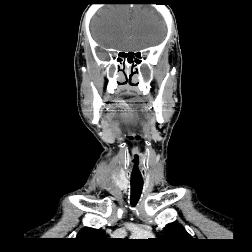Anaplastic thyroid carcinoma (Radiopaedia 79087-92034 A 49).jpg