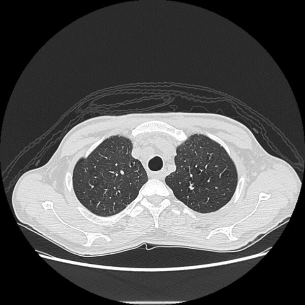 File:Angioinvasive aspergellosis (Radiopaedia 66995-76315 Axial lung window 7).jpg