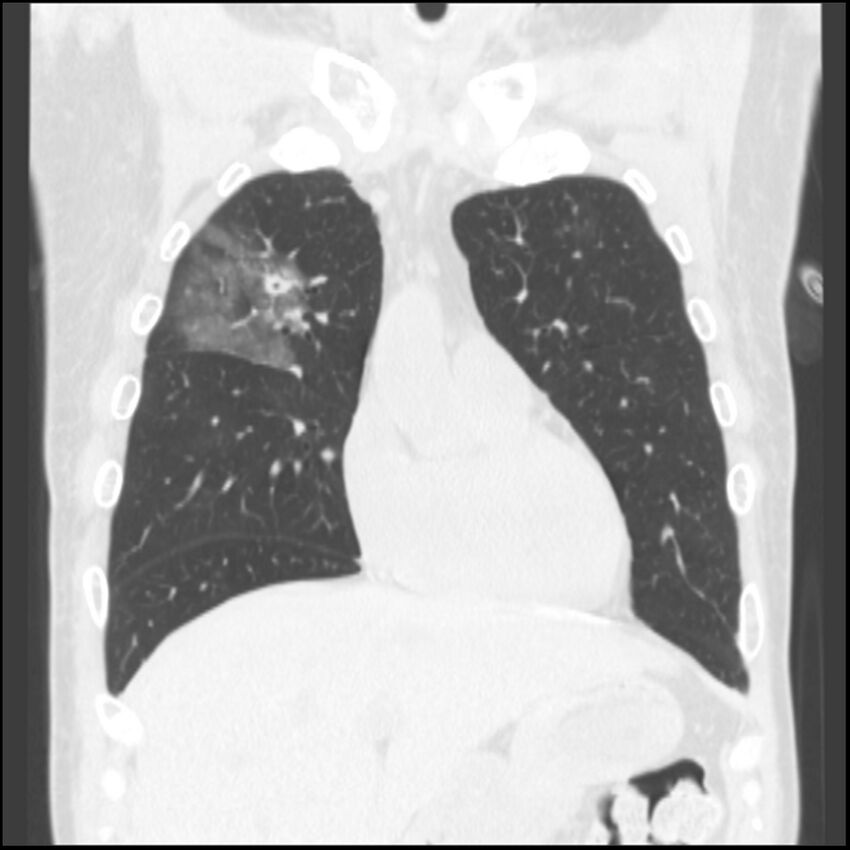 Angioinvasive aspergillosis (Radiopaedia 43957-47466 Coronal lung window 66).jpg