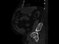 Ankylosing spondylitis (Radiopaedia 44609-48357 Sagittal bone window 77).jpg