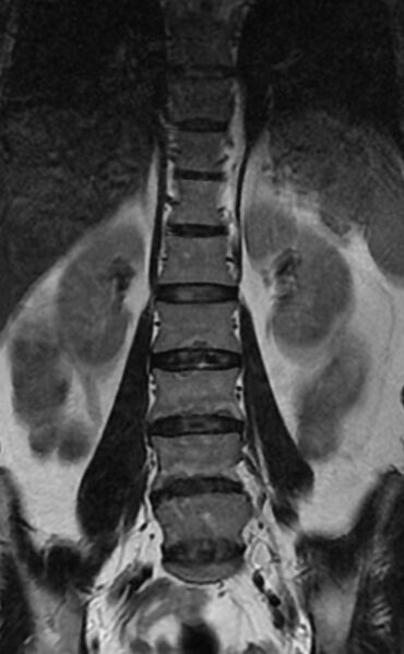 File:Ankylosing spondylitis - Andersson lesion (Radiopaedia 81878-95838 Coronal T2 6).jpg