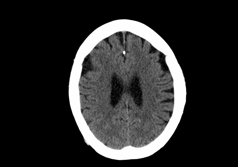 File:Anomalous intracranial venous drainage (Radiopaedia 28161-28418 Axial non-contrast 30).jpg
