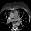 Anomalous origin of left circumflex artery from right coronary sinus (Radiopaedia 72563-83117 A 50).jpg