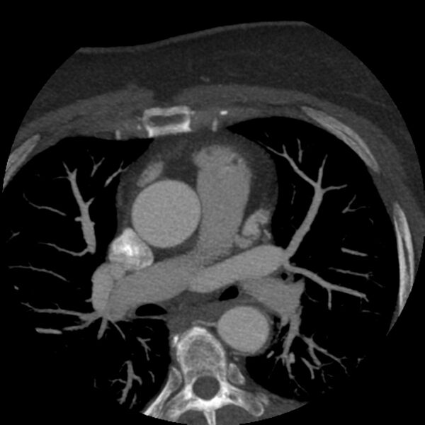 File:Anomalous origin of left circumflex artery from right coronary sinus (Radiopaedia 72563-83117 A 50).jpg