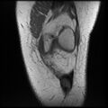 Anterior cruciate ligament tear, Wrisberg rip and bucket-handle tear of medial meniscus (Radiopaedia 75872-87266 Coronal T1 8).jpg