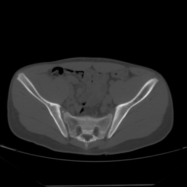 File:Anterior inferior iliac spine avulsion fracture (Radiopaedia 49469-54627 Axial bone window 18).jpg