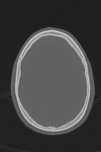 File:Anterior nasal spine fracture (Radiopaedia 46138-50494 Axial bone window 19).png