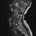 Anterior spinal artery syndrome (Radiopaedia 46335-50750 A 9).png