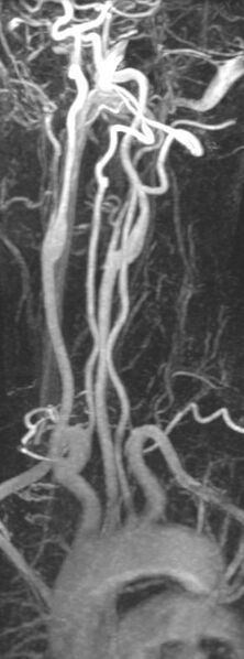 File:Aortic arch origin of left vertebral artery (Radiopaedia 14348-14261 B 1).jpg