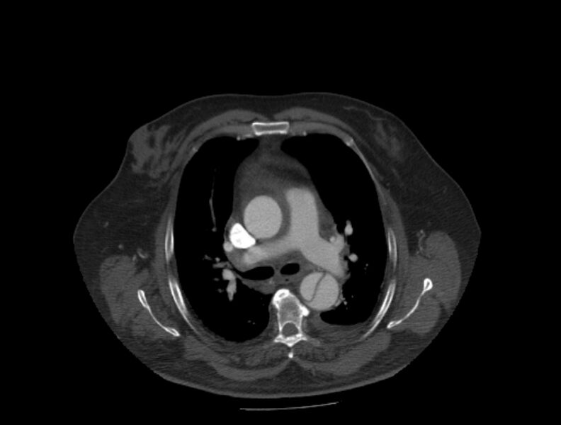File:Aortic dissection (Radiopaedia 28802-29105 A 14).jpg