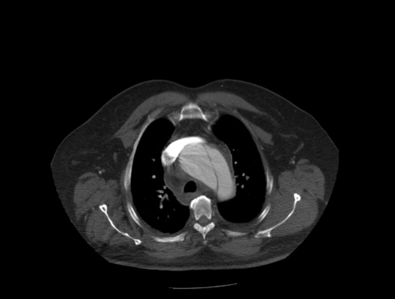 File:Aortic dissection (Radiopaedia 28802-29105 A 6).jpg