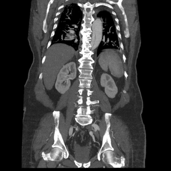 File:Aortic dissection (Radiopaedia 28802-29105 B 28).jpg