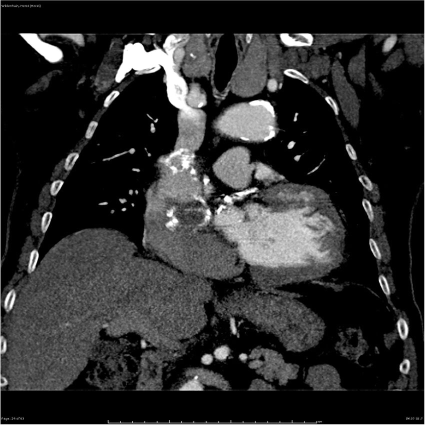 Aortic dissection - Stanford type A (Radiopaedia 26183-26315 A 24).jpg