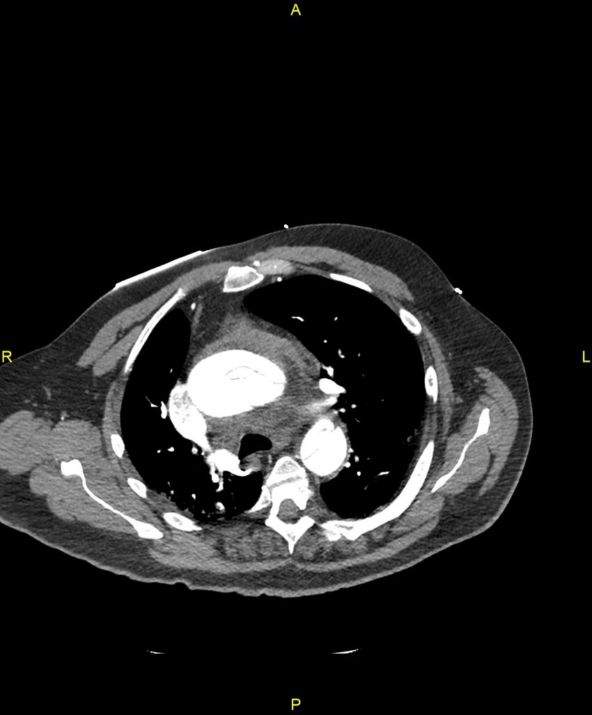 Aortic rupture (Radiopaedia 88822-105594 B 83).jpg
