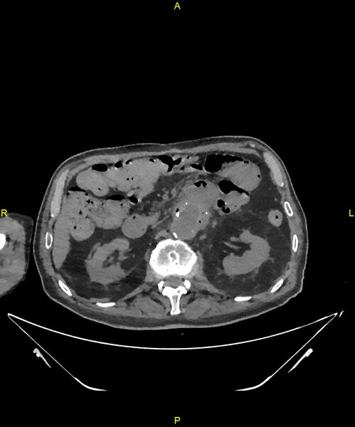 File:Aortoenteric fistula (Radiopaedia 84308-99603 Axial non-contrast 126).jpg