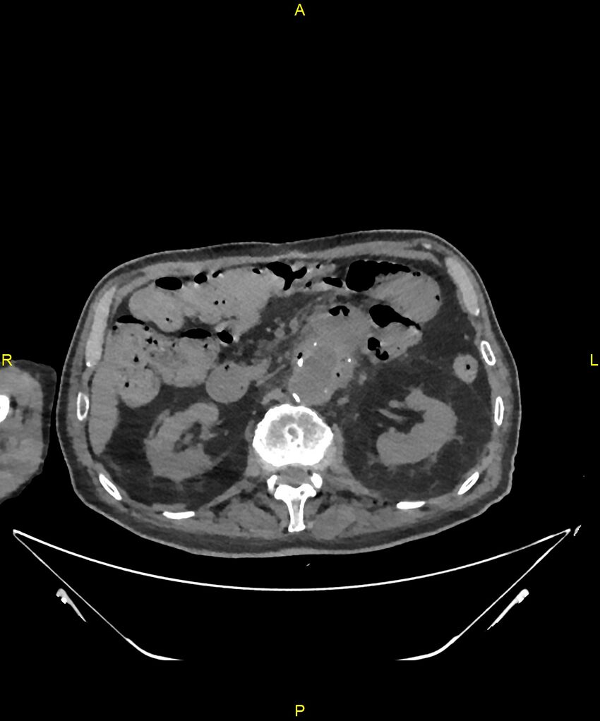 Aortoenteric fistula (Radiopaedia 84308-99603 Axial non-contrast 126).jpg