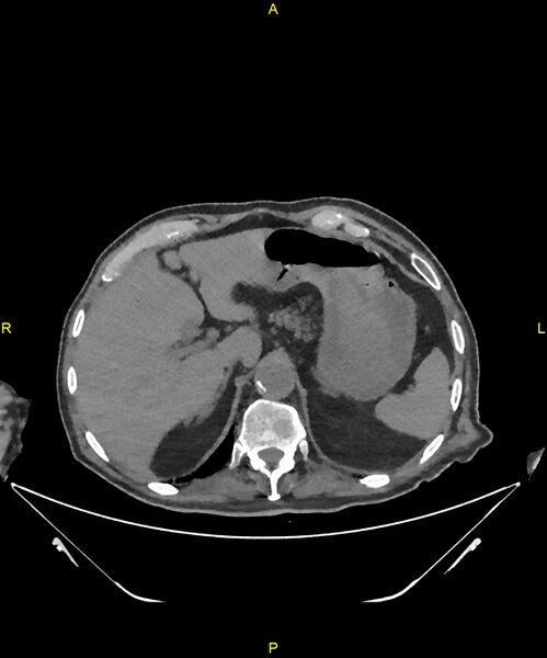 File:Aortoenteric fistula (Radiopaedia 84308-99603 Axial non-contrast 63).jpg